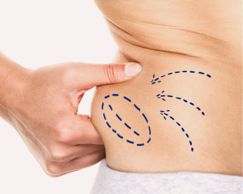 Liposuction